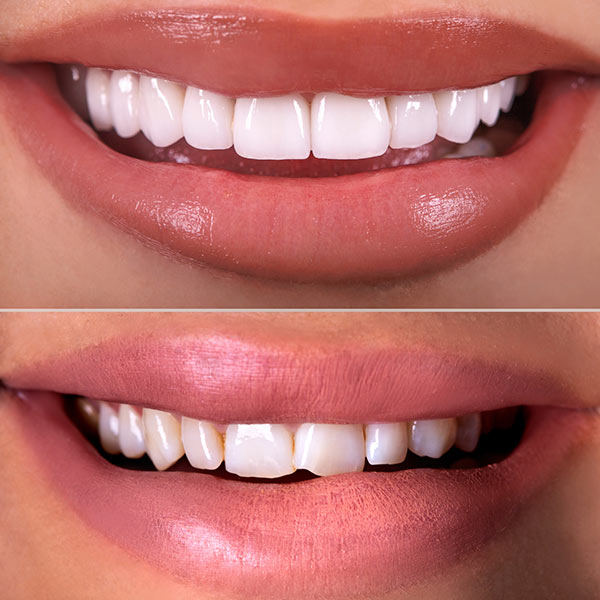 before and after cosmetic dentistry